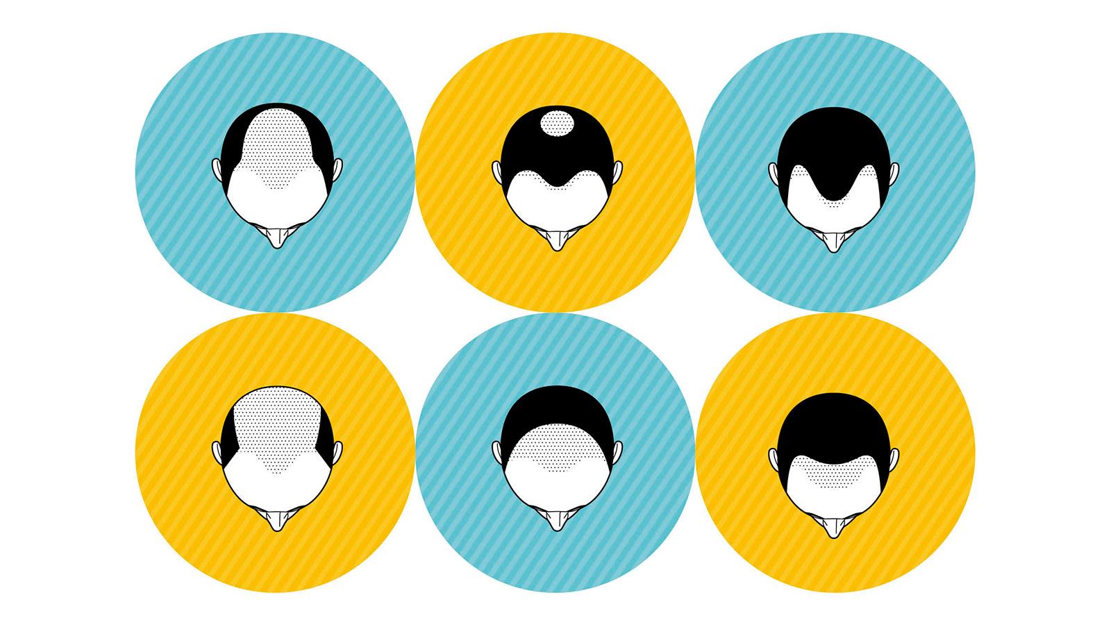 いまさら聞けないAGAって何？ 男性型脱毛のメカニズムと最新治療に迫る！