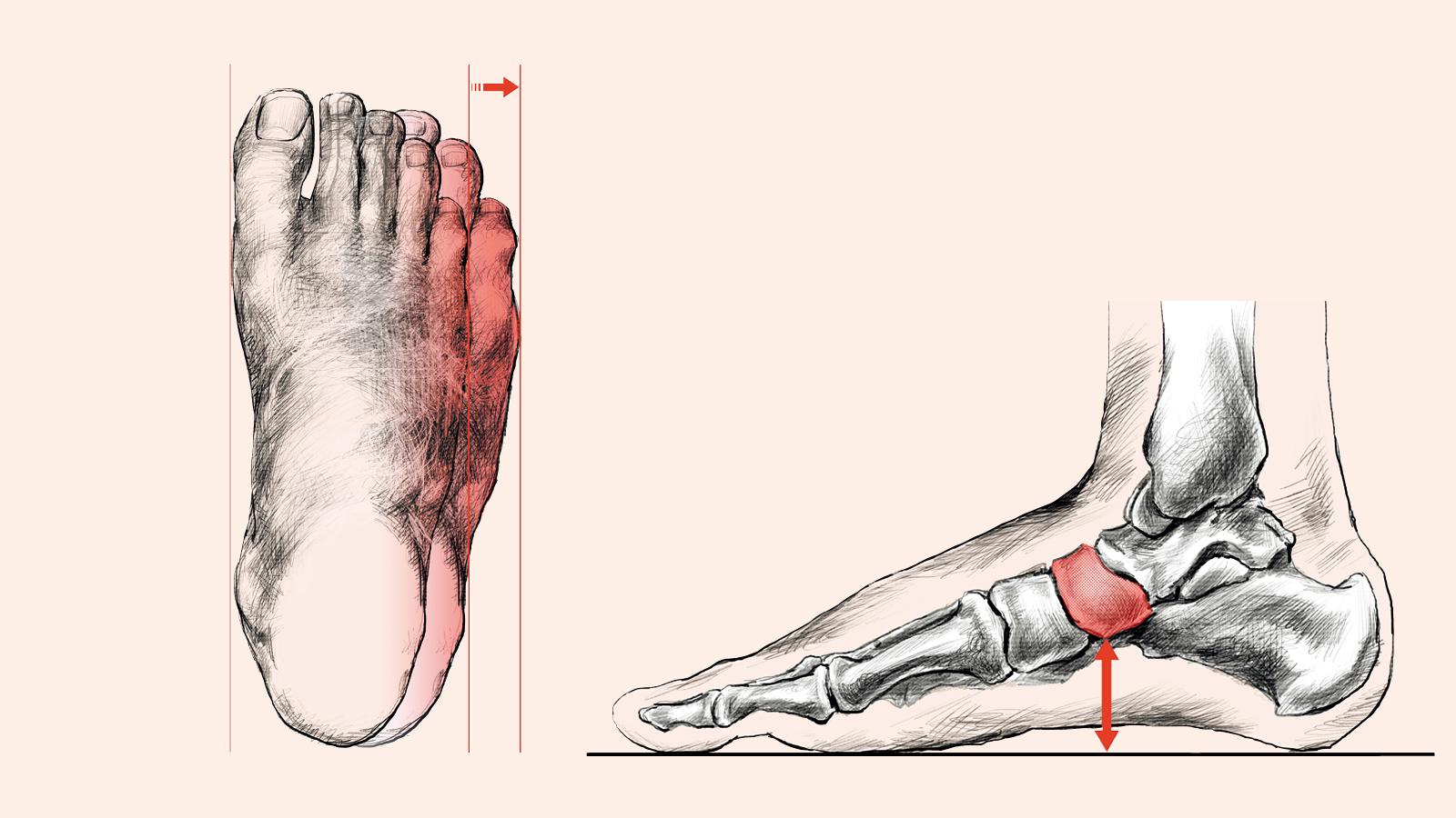 甲高・幅広、外反母趾…。日本人の「足」に関する4つの勘違い