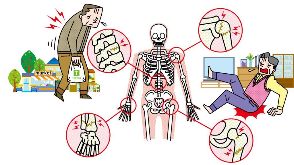 【加齢のトリセツ】女性だけでなく、男性も注意。「骨粗鬆症」の実態