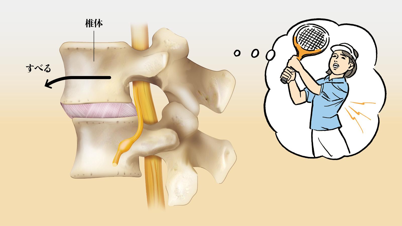 【診察簡易シミュレート】長時間立っていると腰が痛くてたまらない。それ、「腰椎変性すべり症」かも