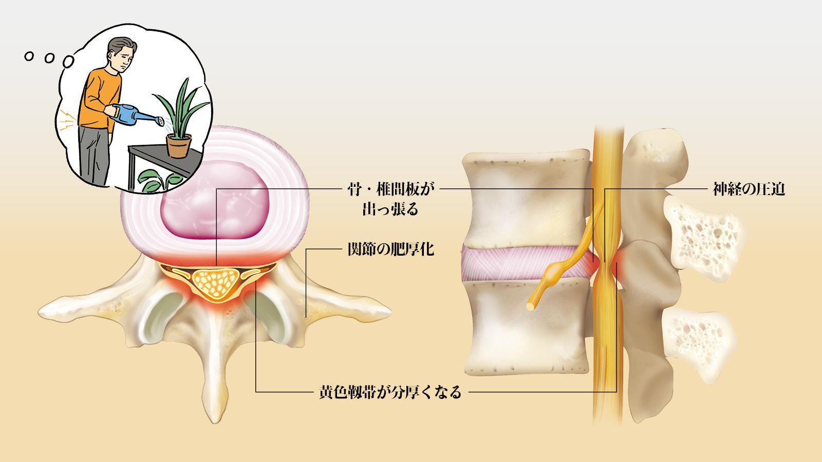 【診察簡易シミュレート】歩き始めて5分もすると腰に痛みが。それ「脊柱管狭窄症」かも