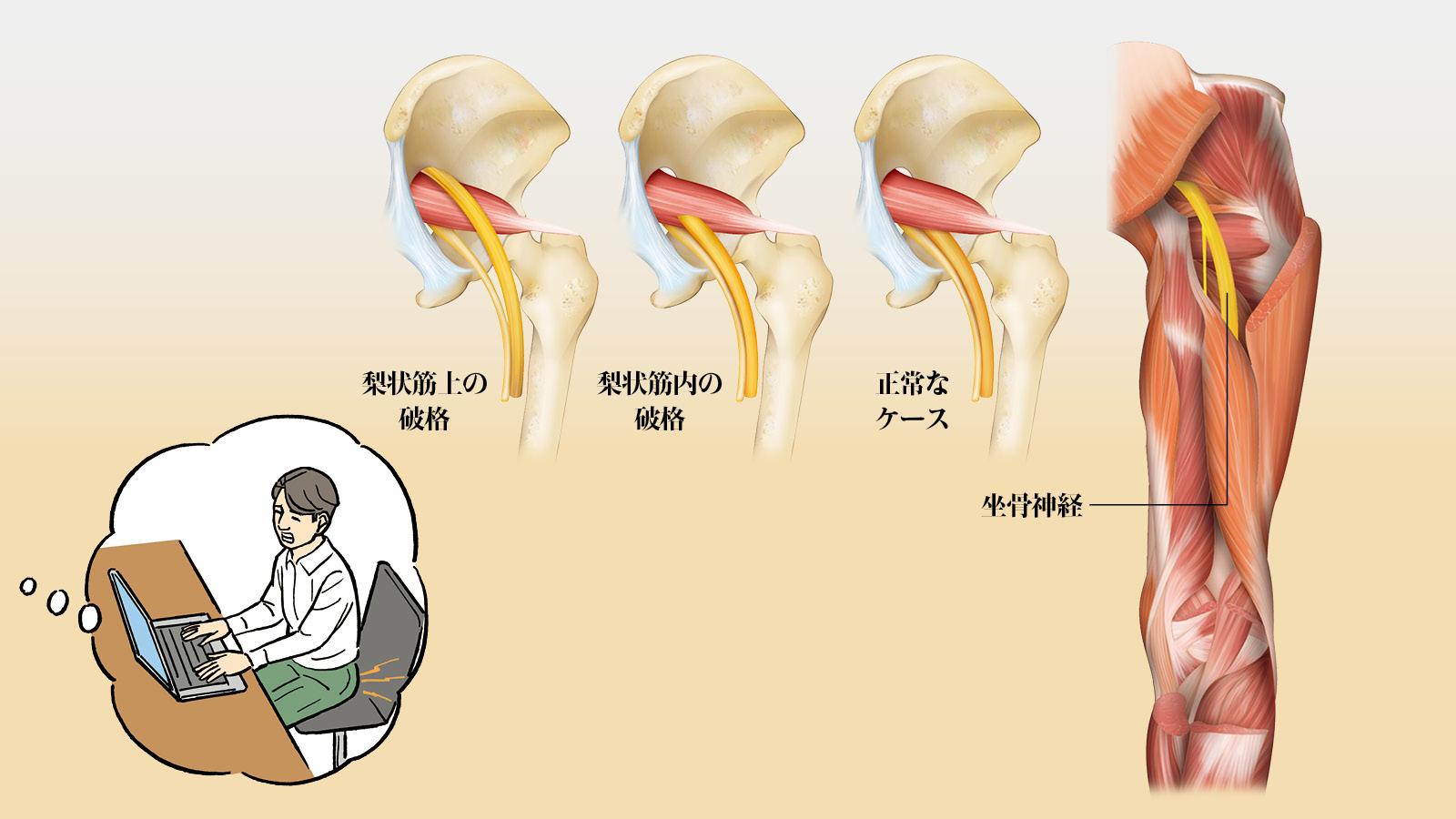 【診察簡易シミュレート】デスクワーク中、お尻のあたりが痛む。それ「特異的腰痛」かも