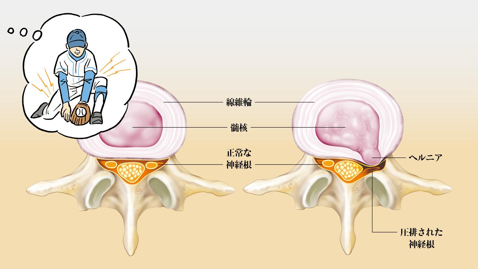 「特異的腰痛」の診察を簡易シミュレート｜椎間板ヘルニアの場合