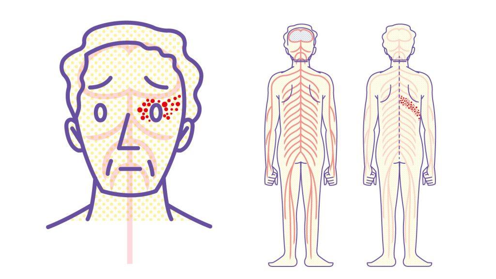 成人の90%以上に発症リスクあり。帯状疱疹の原因と対策