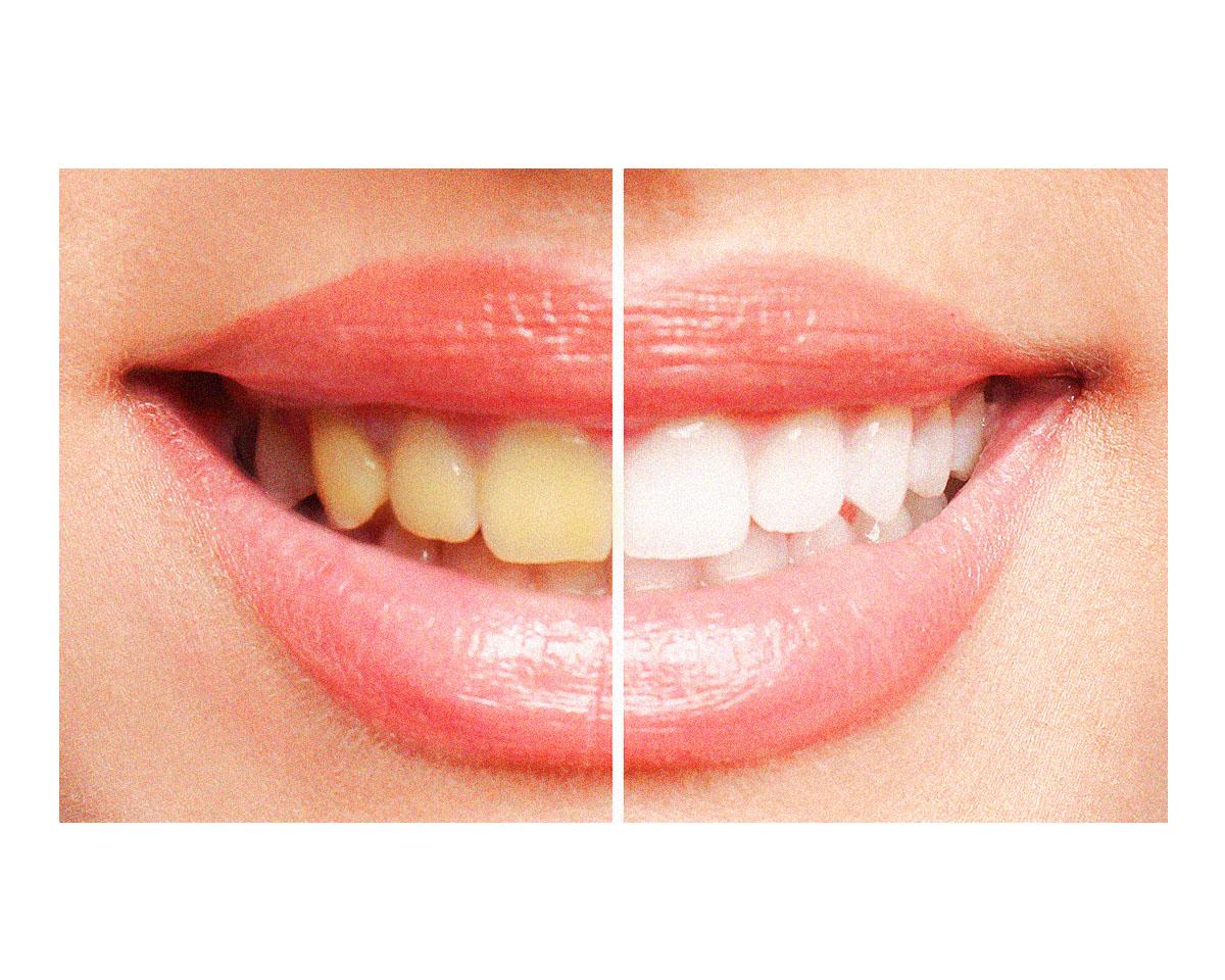 歯の色の画像：左黄ばみ：右白い