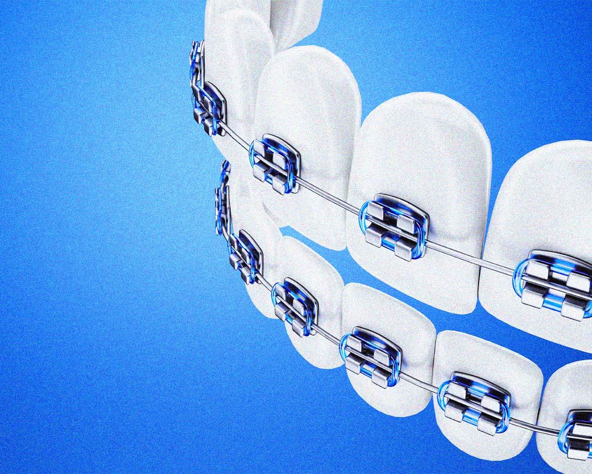 歯科矯正の画像