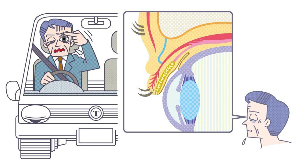 見えにくくなるだけじゃない！ 瞼が垂れ下がる「眼瞼下垂」にご用心【加齢のトリセツ】