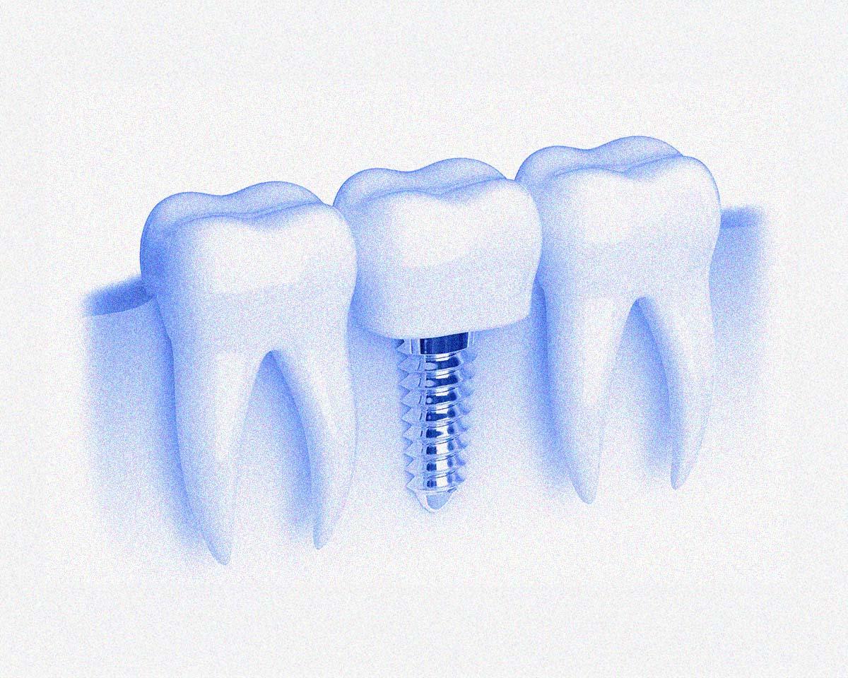 “第2の永久歯”インプラントとは?〈きぬた歯科〉に聞いてみた。